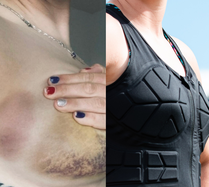 THIS IS A BREAST INJURY